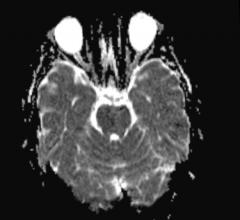 New Study Uses MRI to Probe Psychopathic Brains