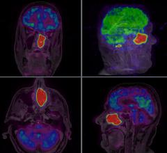 brain metastases, cognitive outcomes, stereotactic radiosurgery, SRS, whole brain radiotherapy, WBRT, Mayo Clinic study