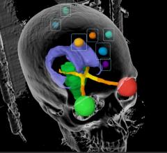 brain metastases, cancer, survey, UCLA, Dr. Percy Lee, whole brain radiotherapy, stereotactic radiosurgery