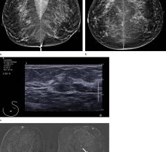 Radiology journal, breast MRI screening, average risk women, breast cancer