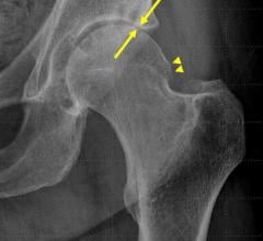 Hip Steroid Injections Associated with Bone Changes