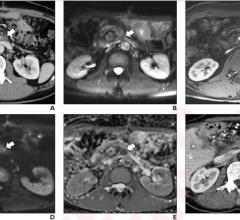 48-year-old man who underwent pylorus-preserving pancreatoduodectomy with superior mesenteric vein resection and reconstruction for pancreatic ductal adenocarcinoma (T3N1).