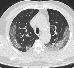 Chest CT imaging of patient. #coronavirus #nCoV2019 #2019nCoV #COVID19 