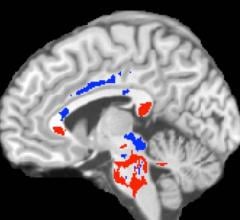concussion outcomes, MRI, DTI, diffusion tensor imaging, Albert Einstein College of Medicine, Montefiore