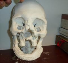  3-D printed model to guide face transplant