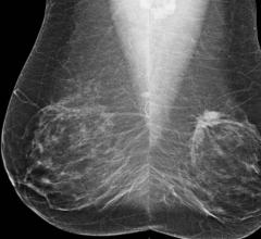 RSNA 2014, risk-based cancer screenings, mammography