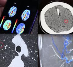 Artificial intelligence (AI) was again the hottest topic in radiology, with 11 of the top 20 pieces of content this month relating to AI. These images are a few of the AI technologies highlighted in ITN Editor's Choice video of the most innovative AI technologies highlighted at RSNA 2018. 