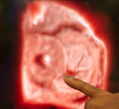 An example of Philips’ TrueVue technology, which offers photo-realistic rendering and the ability to change the location of the lighting source on 3-D ultrasound images. In this example of two Amplazer transcatheter septal occluder devices in the heart, the operator demonstrating the product was able to push the lighting source behind the devices into the other chamber of the heart. This illuminated a hole that was still present that the occluders did not seal.