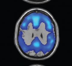 Biopharmaceuticals Inc. Clinical Study Alzheimer's Beta Amyloig