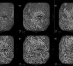 The benefits of adding whole breast automated ultrasound (ABUS) screening to clinical practice, enhancing cancer detection in the setting of dense breast tissue