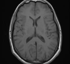 Contrast Agent Linked With Brain Abnormalities on MRI 