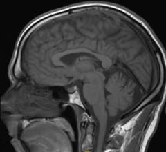 gadolinium, brain, contrast MRI, Radiology, Kanal, brain, brain MRI with contrast