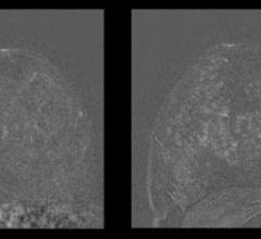Figure 1. Left image shows breast MRI in 41-year-old patient without IUD. Right image shows increased parenchymal enhancement in the same patient 27 months after IUD placement.