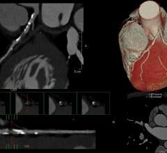 CT angiography, CTA, coronary CT, cardiac CT, SCCT, society of cardiovascular computed tomography, cardiac imaging