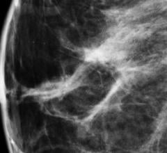 Mayo Clinic, breast density, awareness, women's health, mammography