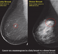 A comparision of a small breast cancer found in a patient without dense breast tissue (left), and a tumor found in a woman with dense fibroglandular tissue. Fibroglandular Dense Breast tissue Comparison 