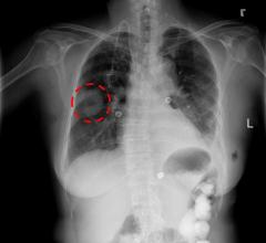 Chest X-ray AI Algorithm Correctly Identifies Lung Disease for Dubai Health Authority
