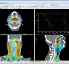 Differences between VMAT and tomotherapy help increase efficiency in radiation oncology