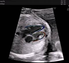 Cardiac Ultrasound Software Streamlines Fetal Heart Exams