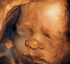 3-D ultrasound, 3D ultrasound, fetal ultrasound
