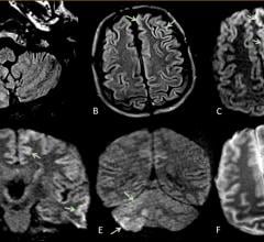 This is Figure 2 from the article in Radiology: Acute encephalopathy. A 60 year-old-man without history of seizures presenting with convulsion. (A-B) Multifocal areas of FLAIR hyperintensity in the right cerebellum (arrows in A), left anterior cingular cortex and superior frontal gyrus (arrows in B). (C-D) Restricted diffusion in the left anterior cingulate cortex, superior frontal and middle temporal gyrus (arrows in D) and right cerebellum (arrows in E), consistent with cerebellar diaschisis. F)  #COVID19
