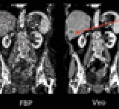 liver metastasis, iterative reconstruction