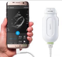 The Philips Lumify hand-held ultrasound technology is an important component of the mobile ECMO unit. Members of the ECMO team use Lumify for real-time visual guidance when inserting tubes in veins and arteries in a process called ECMO cannulation. #RSNA2019 #RSNA19 #POCUS