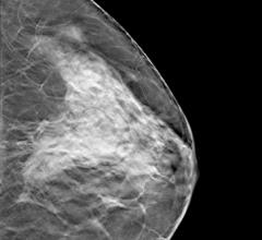 dense breast tissue