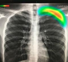 This is a lung X-ray reviewed automatically by artificial intelligence (AI) to identify a collapsed lung (pneumothorax) in the color coded area. This AI app from Lunit is awaiting final FDA review and in planned to be integrated into several vendors' mobile digital radiography (DR) systems. Fujifilm showed this software integrated as a work-in-progress into its mobile X-ray system at RSNA 2019. GE Healthcare has its own version of this software for its mobile r=ray systems that gained FDA in 2019.   #RSNA #