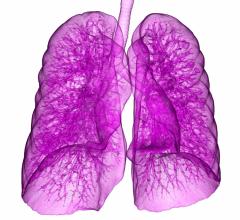 lung cancer, Lung-RADS, ACR, guidelines, study, CT, computed tomography