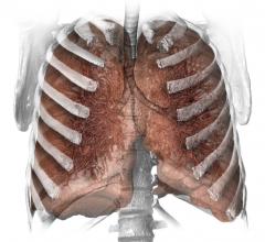 smoking, lung cancer, CT screening, guidelines