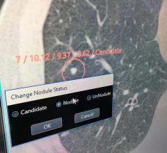 An example of artificial intelligence (AI) being developed by Hitachi to automatically review and identify nodules on lung CT scans. This is part of a suite of AI apps Hitachi is developing. This example was being shown as a work in progress at RSNA 2019.