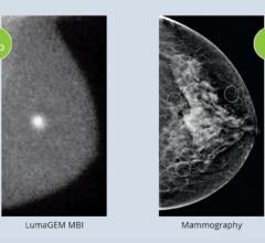 A comparison between mammography vs. molecular breast imaging (MBI).