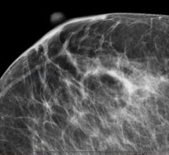 USPSTF, breast cancer, screening, recommendations