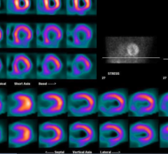A Tc99m SPECT cardiac exam showing myocardial perfusion in the heart.