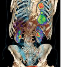 PET/CT scanners allow for precise anatomic localization of molecular data and simultaneous anatomic evaluation in a single exam. Depicted here is lung cancer. (Photo courtesy of Siemens Healthcare)