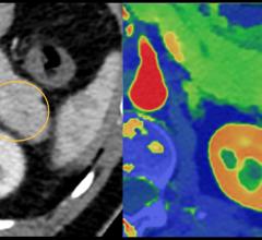 An example of how spectral CT can help aid diagnosis in a pancreatic CT which may have a small lesion, but it is difficult to see. The dual-energy imaging clearly shows a lesion. This is example is from the Philips Spectral CT 7500 system.