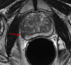  Prostate MRI showing tumor 2_From Philips MRI webinar for ITN