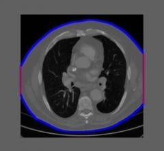 Example of an intentionally truncated CT image