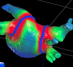 A CyberHeart cardiac ablation radiotherapy treatment plan showing where the radiation beam will ablate for a noninvasive pulmonary vein isolation procedure. Varian acquires, buys, purchases Cyberheart.