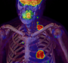 nuclear imaging spect spect/ct IMV