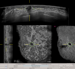 This image depicts ABUS images with QVCAD results