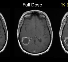 This image is of an 80 kg woman with a newly diagnosed IDH-wildtype glioblastoma