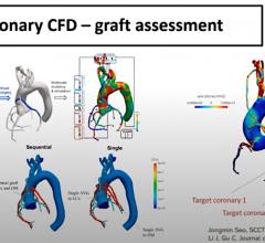 Sheer stresses on the walls of arteries are believed to cause the formation atherosclerotic plaques. This is an area of research that is expected to see increased use in the next few years. This study was presented at SCCT 2020 as an example of how sheer stresses can help evaluate and predict the patency of coronary artery bypass grafts (CABG).