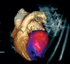 perfusion imaging, CT perfusion