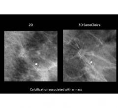 GE, SenoClaire, mammography, 3-D breast imaging, tomosynthesis, dense breast tissue