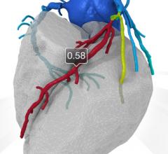 The Latest Advances in Coronary CT Angiography Software