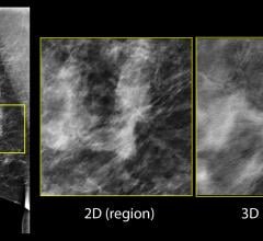 tomosynthesis, 3D mammography