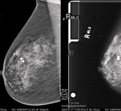 digital mammography
