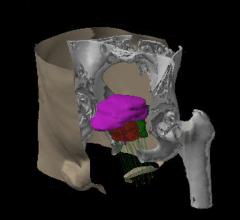 Varian Vitesse Brachytherapy Systems evine Cancer Institute